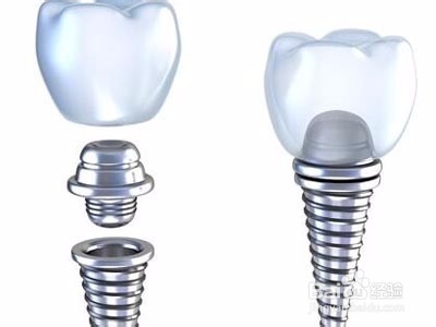 假牙的种类及价格