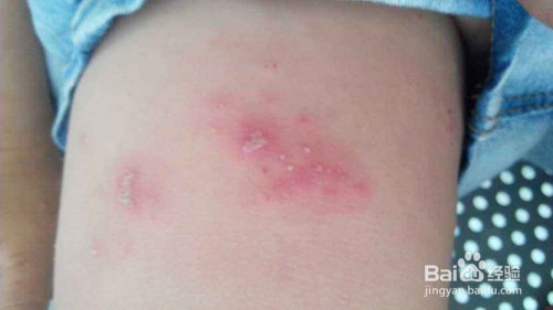 隐翅虫咬人后图片 治疗方法