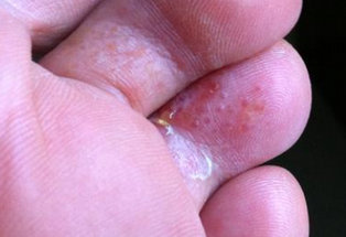 白醋泡脚治脚气