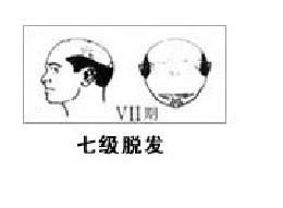 男性流花植发有哪些优点和特点?