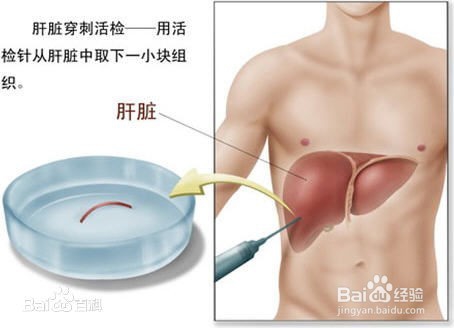 乙肝病毒dna定量结果如何看