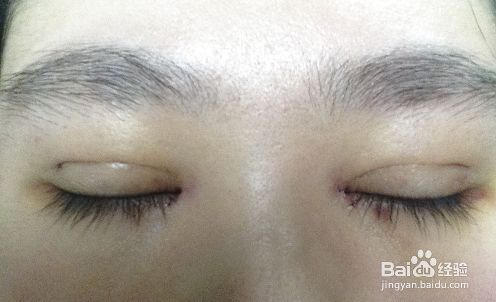 开眼角后常常无刺激下流眼泪怎么办？