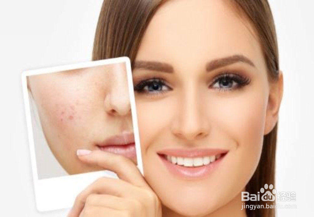 如何做才能摆脱长痘痘的苦恼