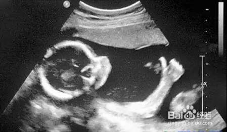 如何识别B超、X线、CT、核磁的共振的不同用途