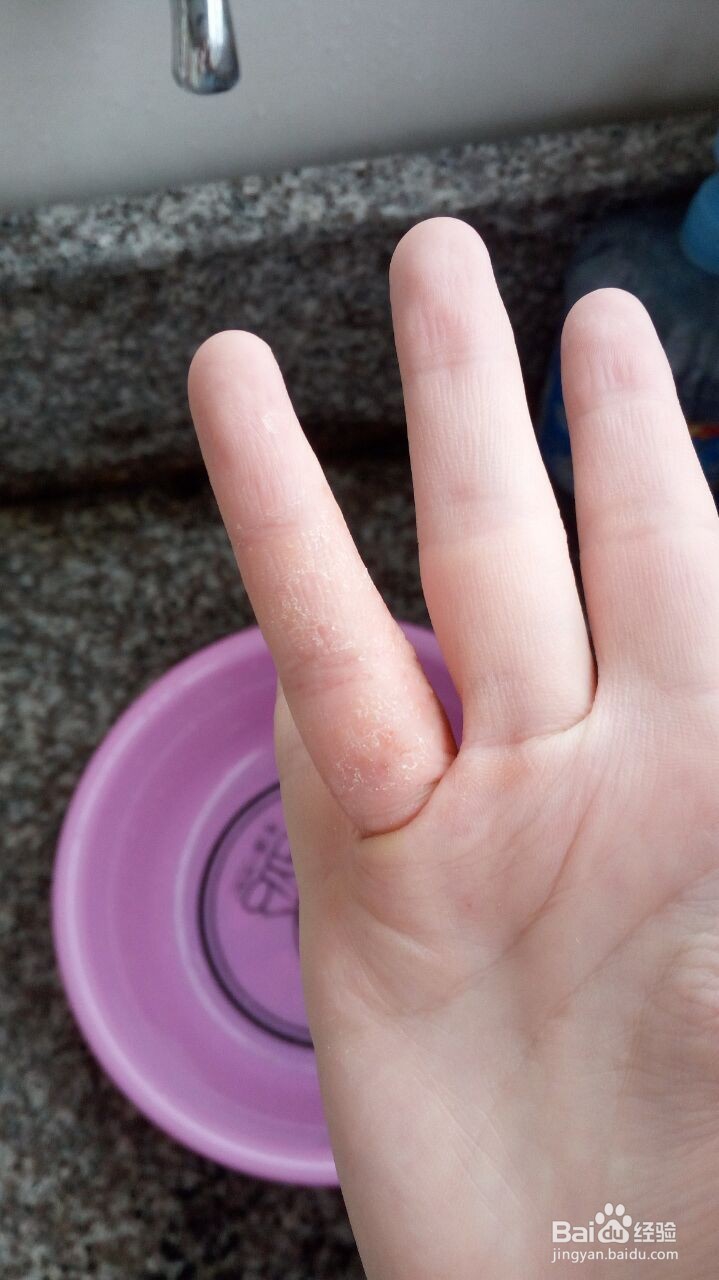 手指小水泡的治疗过程（真实经验）