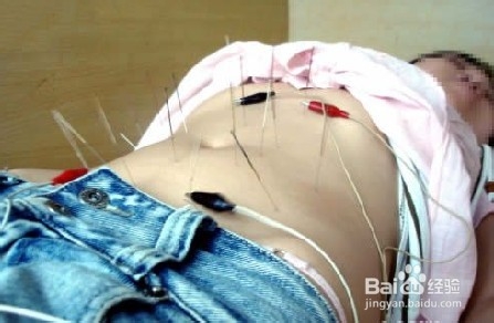 针灸减肥有哪些五个误区