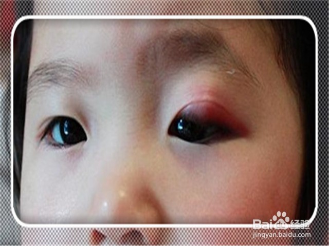 <b>眼皮上的麦粒肿有啥保养办法消除</b>