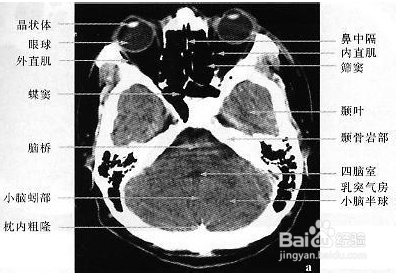 中风偏瘫：[2]脑血管疾病要做哪些检查