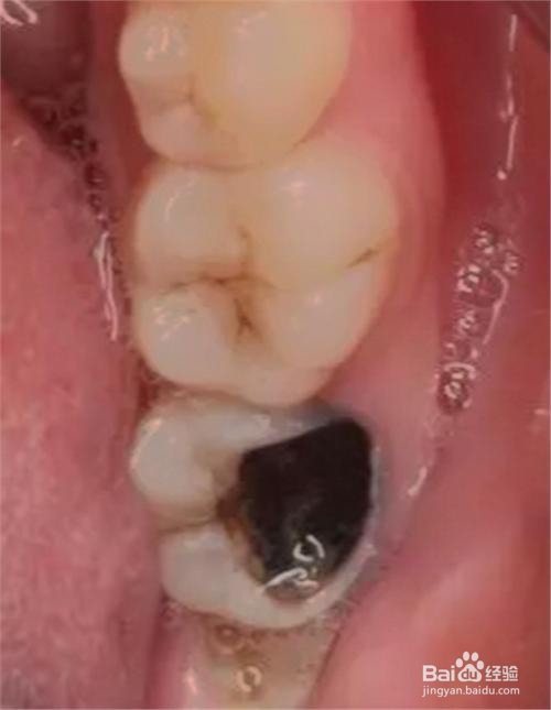 为什么牙齿要做根管治疗？根管治疗的步骤