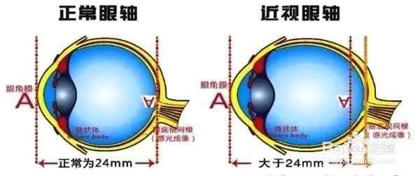 眼睛近视怎么恢复?怎样使眼睛不再近视下去?