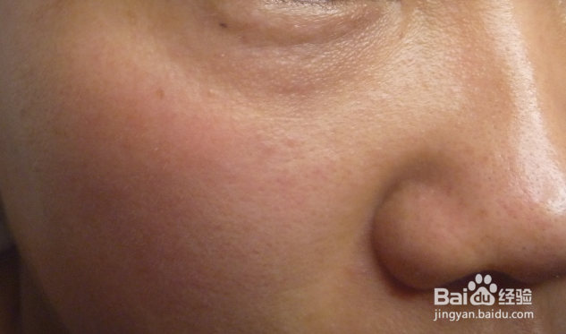 脸上长小疙瘩，可能是汗管瘤，也可能是这些疾病