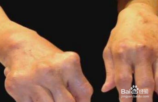 哪些情况需要到风湿免疫科就诊