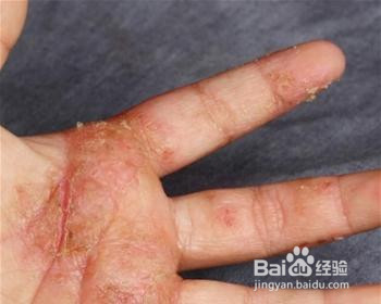 夏季如何预防常见皮肤病