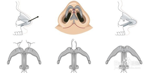 鼻尖整形方法的有哪些