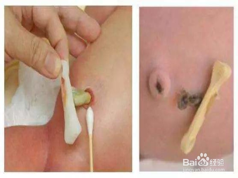 如何护理好宝宝的脐带