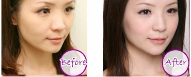 鼻子塌想做隆鼻手术多少钱