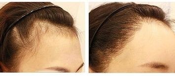 M型 美人尖如何区分