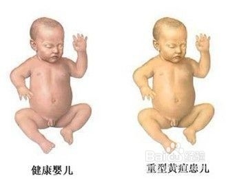 新生儿黄疸如何处理？