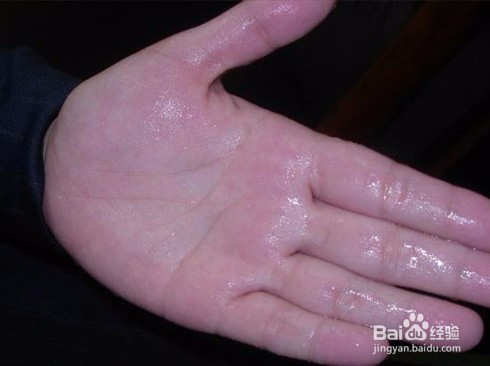 夏天手汗出汗多怎么办？夏天手汗止汗的办法