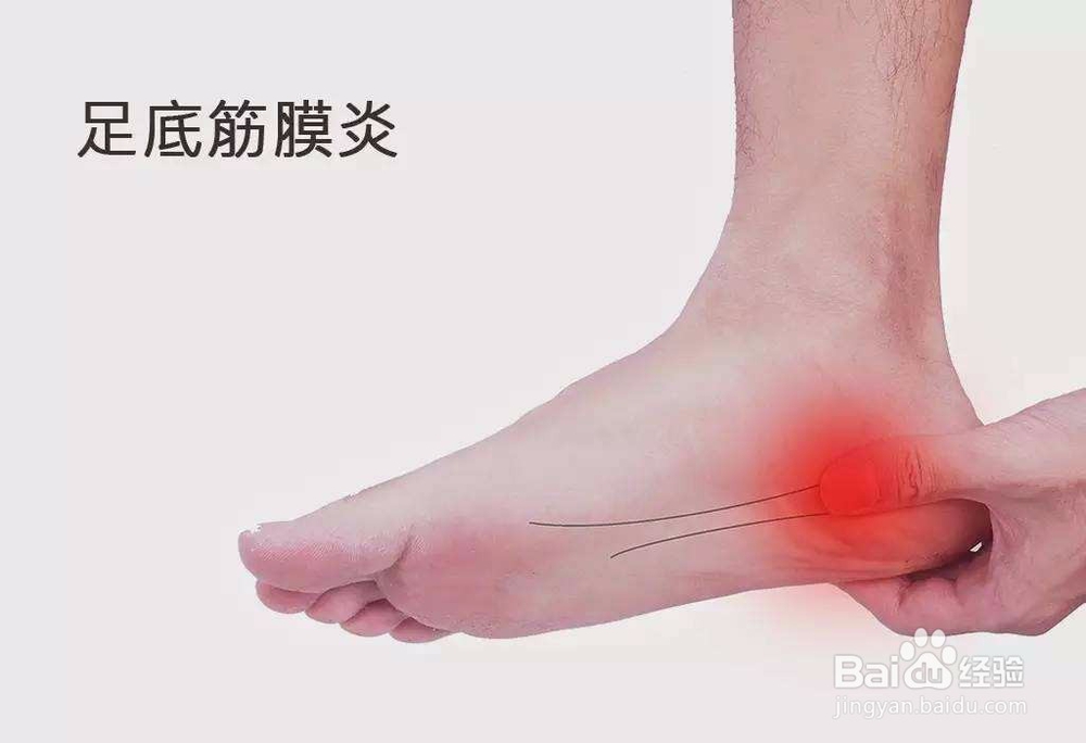 如何避免筋膜炎的发生