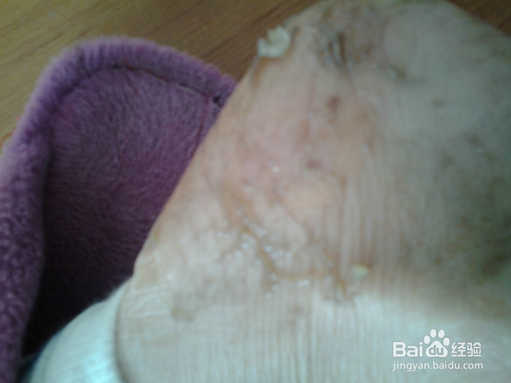 香蕉皮巧治皲裂