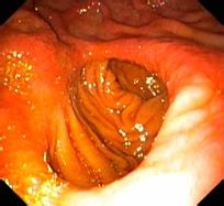 糜烂性胃炎的症状