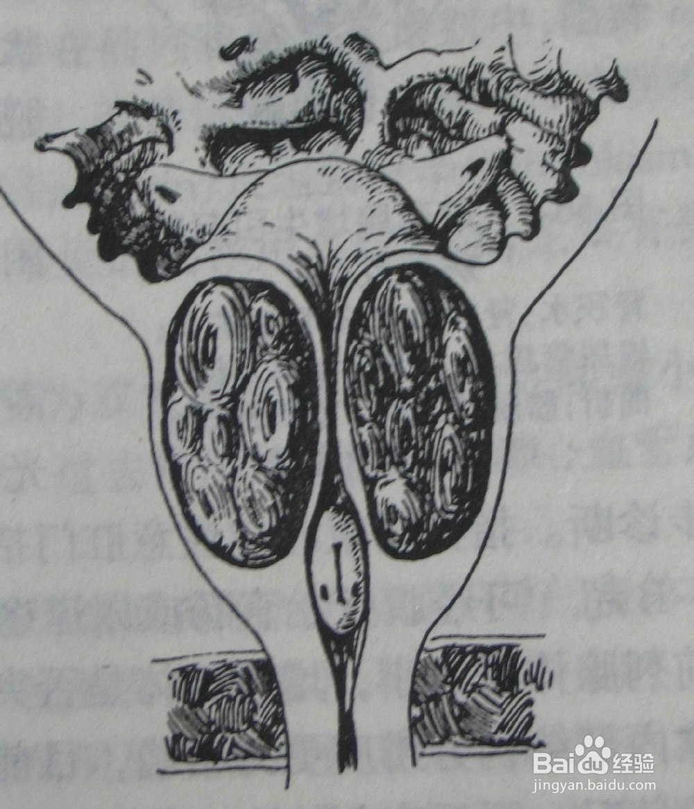 良性前列腺增生?