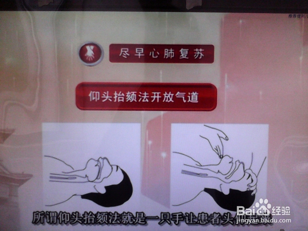 心脏骤停的现场急救