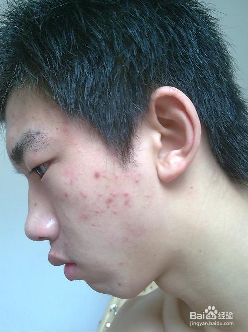 如何去脸上的痘坑
