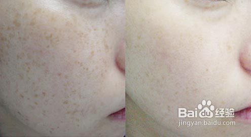 准妈妈孕期皮肤发生的几种变化