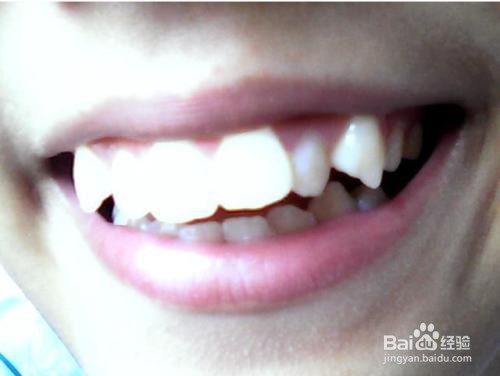 为什么牙齿需要矫正?