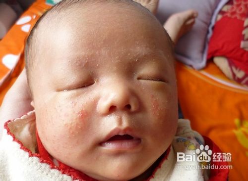 儿童湿疹怎么治疗