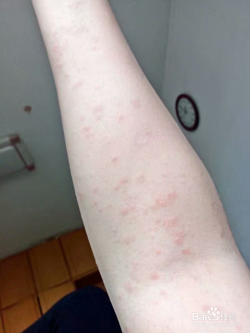 不吃药治疗玫瑰糠疹的正确方法