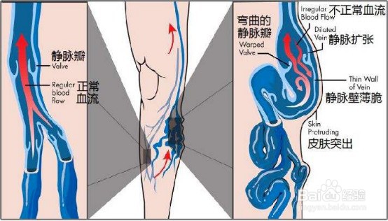 穿高跟鞋会得静脉曲张！美女们要注意了
