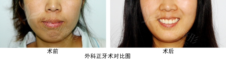 一起了解一下牙齿纠正要多少钱呢?