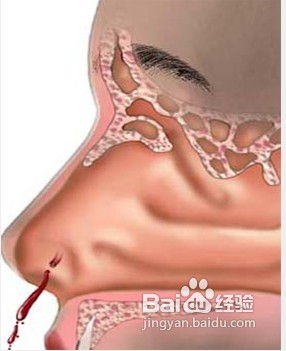 经常流鼻血是怎么回事?