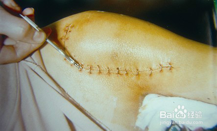 皮肤吻合器使用步骤和拆钉器使用方法