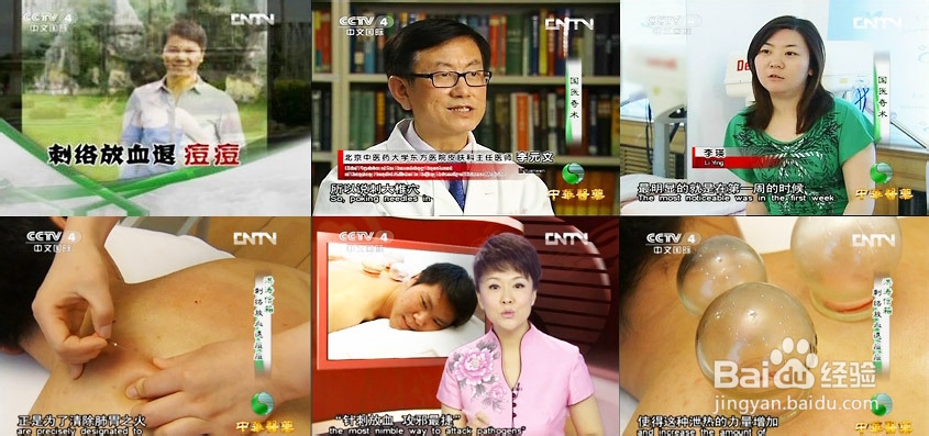 刺络放血疗法治痤疮