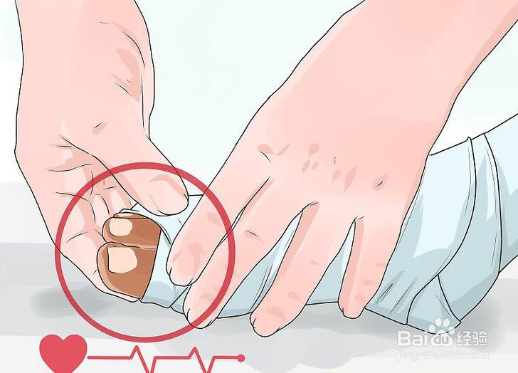 如何使用压力绷带