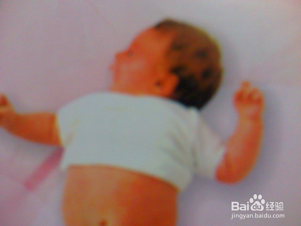 谈谈年轻爸爸妈妈不能忽视刚出生婴儿常见病之四