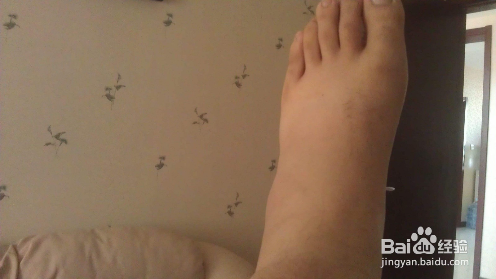 日常去淤青方法