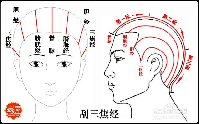 头部刮痧:头痛头晕、眼睛干涩、无精打采