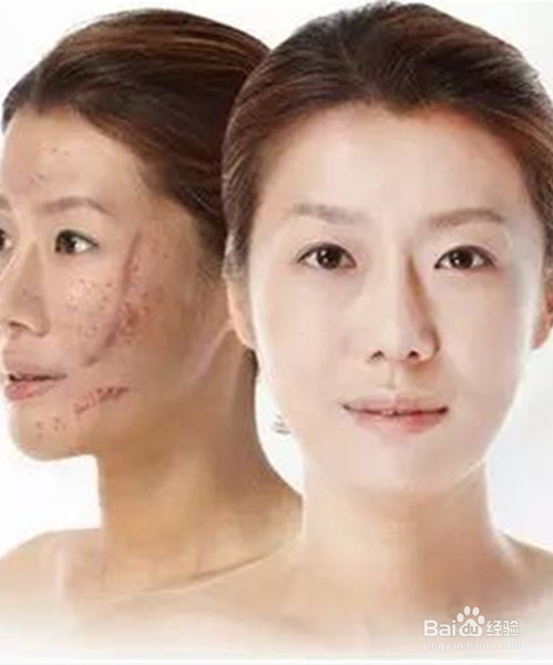 剖腹产疤痕如何去除