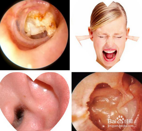 耵聍对生活的影响及如何正确挖取耵聍