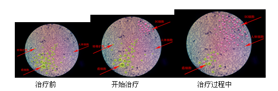 宫颈癌的治疗方法