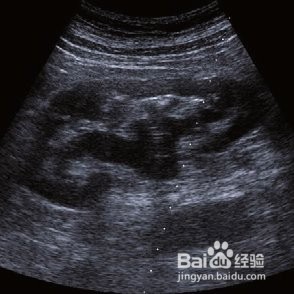 孕检出现唐筛高危、肾盂增宽异常等情况怎么办？