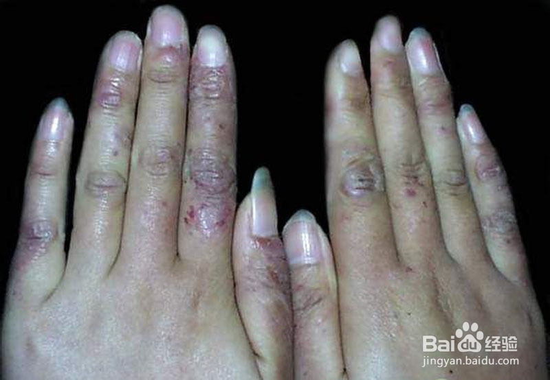 冬季手长冻疮了怎么办？