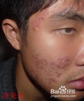 怎样去掉脸上的痘印