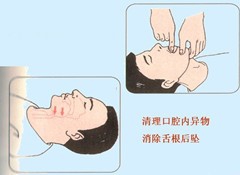 呼吸心跳停止如何进行心肺复苏术