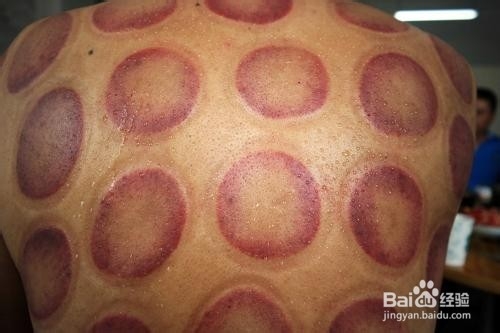 湿气去除的三大步骤